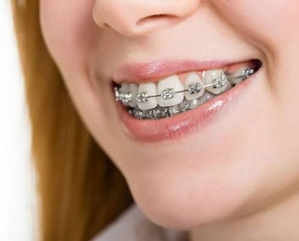 металеві брекети у Львові