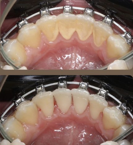 відгуки про ультразвукову чистку зубів