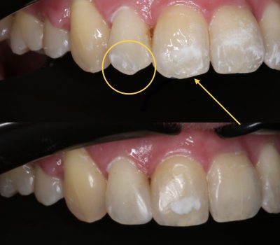 художня реставрація зубів львів ціни