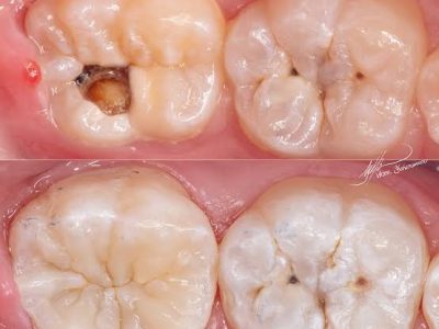 художня реставрація зубів фото