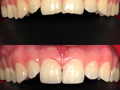 художня реставрація зубів львів