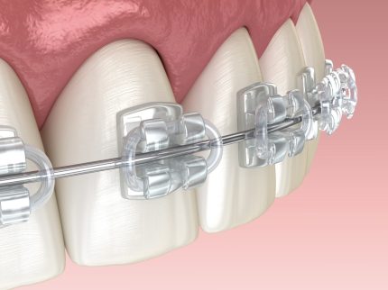 Mandibular jaw and Clear braces. Medically accurate dental 3D illustration