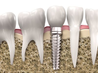 імплантація зубів під ключ у Львові