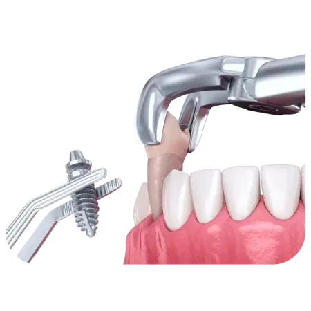 Одномоментна та одноетапна імплантація зубів