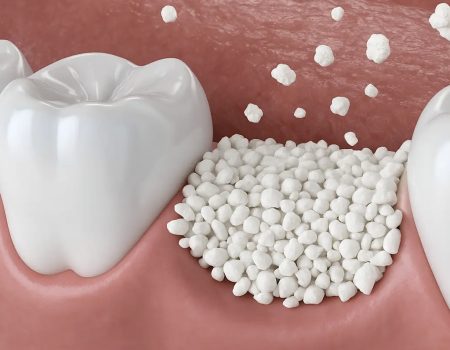 нарощування кістки щелепи