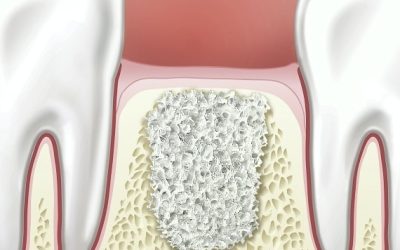 підсипання кістки