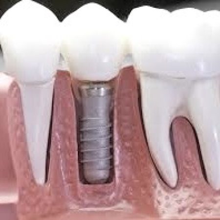 імпланти осстем Корея