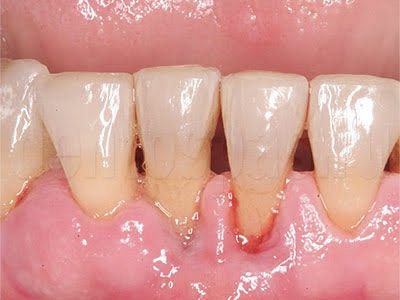 пародонтит фото