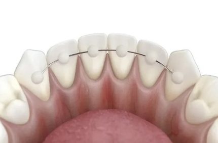 ретейнер після брекетів