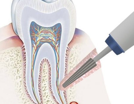 резекція верхівки кореня