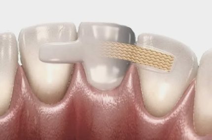 шинування зубів скловолоконною стрічкою