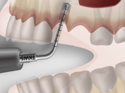 синус ліфтинг у Львові