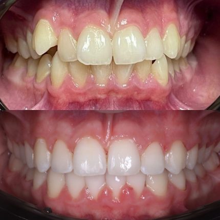 Відбілювання зубів системою Opalescence у Львові