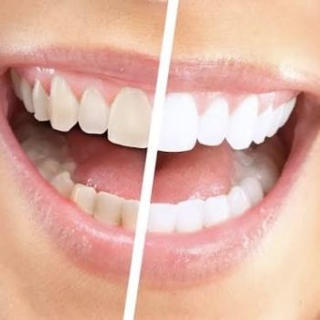 Відбілювання зубів системою Opalescence у Львові