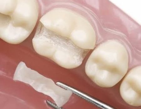 керамічні накладки на зуби, керамічні вкладки